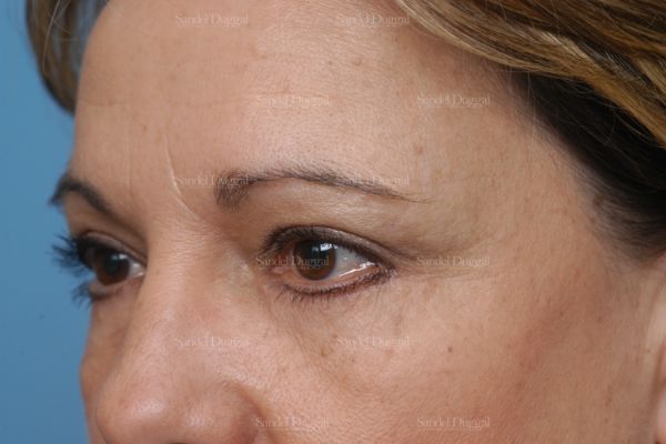 Forehead Lift after, case 2226