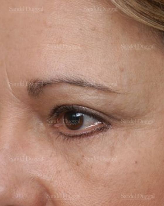 Forehead Lift after, case 2226