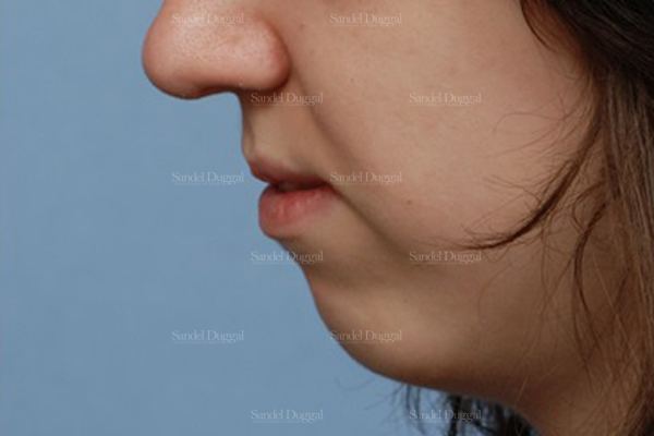 Chin Augmentation before, case 1469