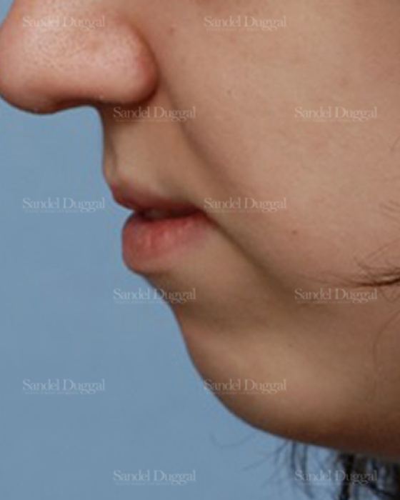 Chin Augmentation before, case 1469