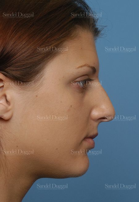 Rhinoplasty before, case 2885