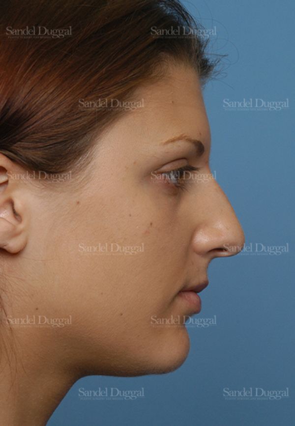 Rhinoplasty before, case 2885