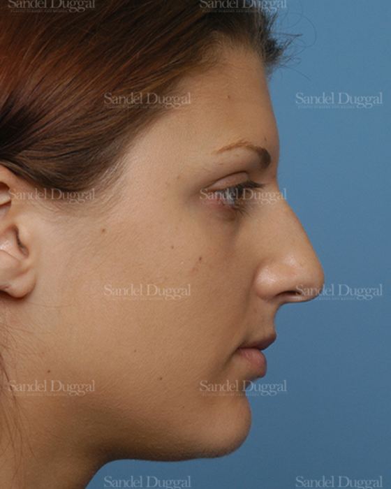 Rhinoplasty before, case 2885