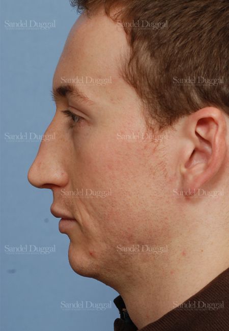 Rhinoplasty before, case 2899