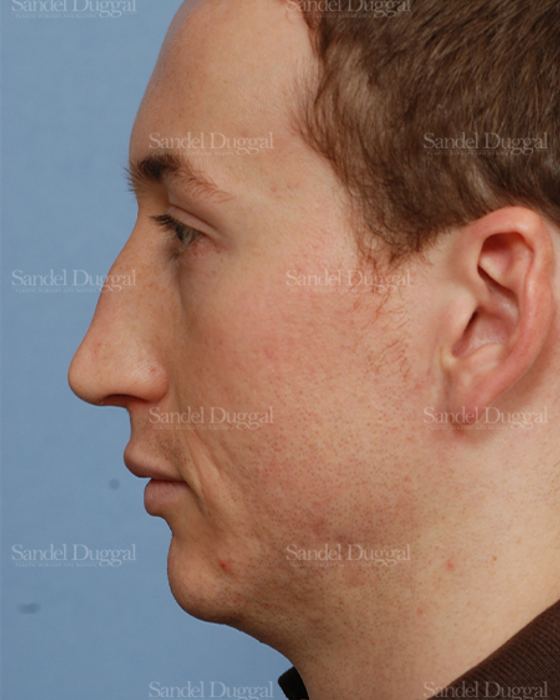 Rhinoplasty before, case 2899