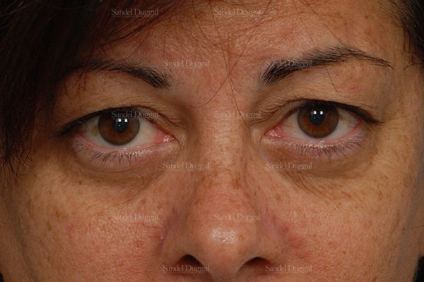 Eyelid Rejuvenation before, case 1922