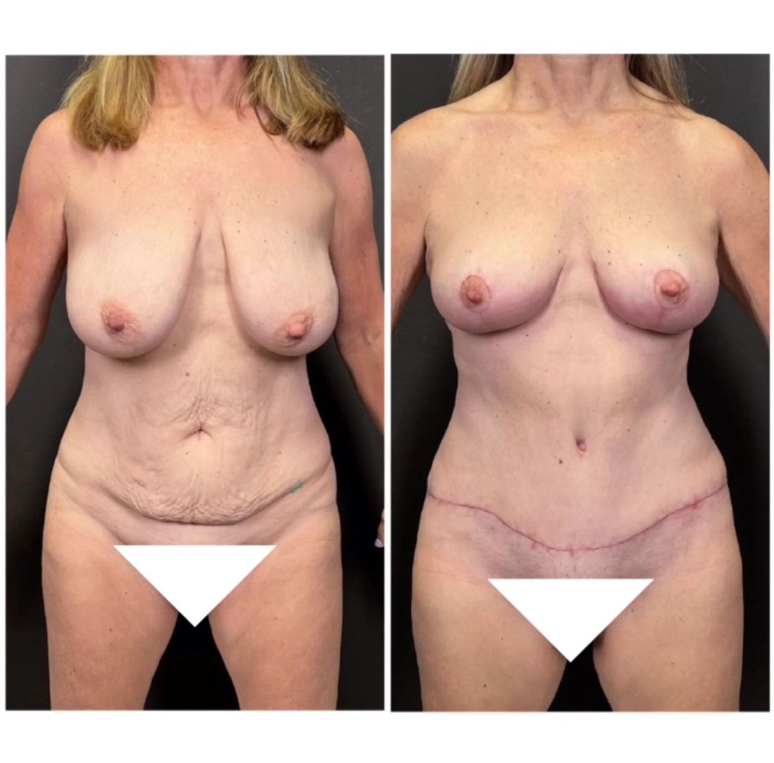 Mommy Makeover before and after, case mommy-makeover-10