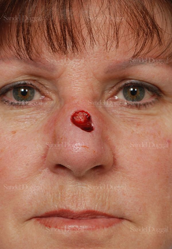Reconstruction after Mohs before, case 2811