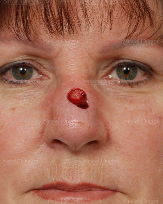 Reconstruction after Mohs before, case 2811