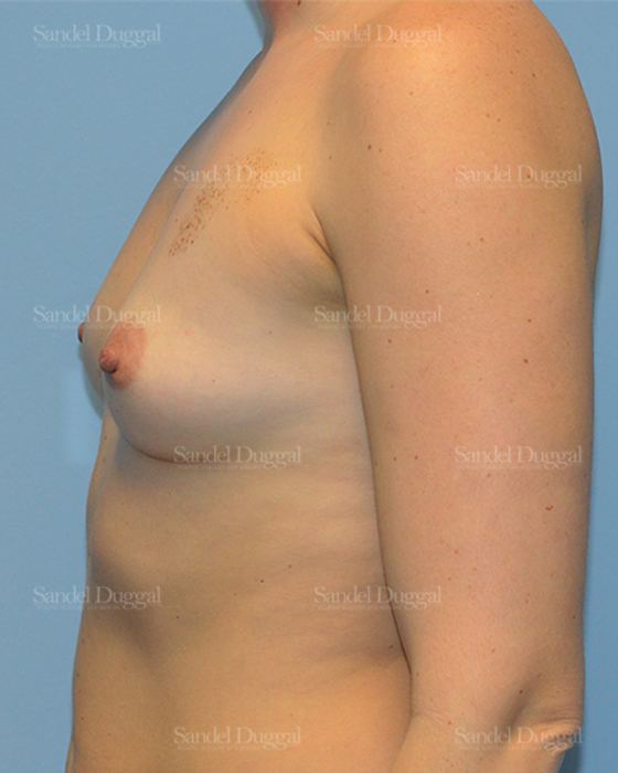 Breast Augmentation before, case 3122