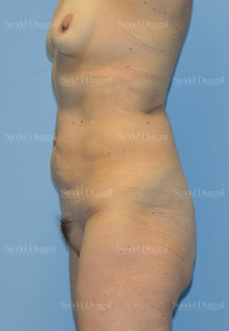 Mommy Makeover before, case 799