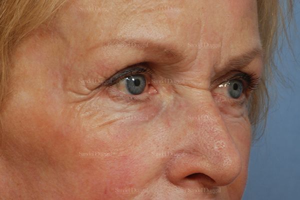 Eyelid Rejuvenation after, case 1951