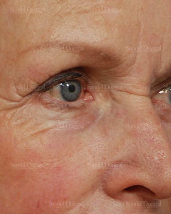 Eyelid Rejuvenation after, case 1951