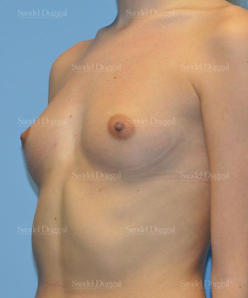 Breast Augmentation before, case 3080