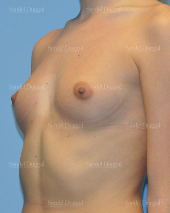 Breast Augmentation before, case 3080