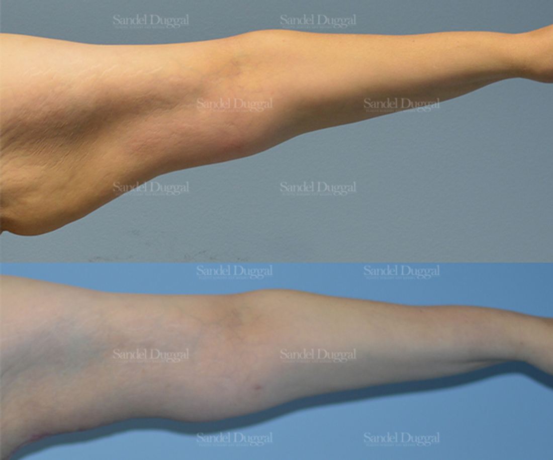 Brachioplasty before and after, case 2134