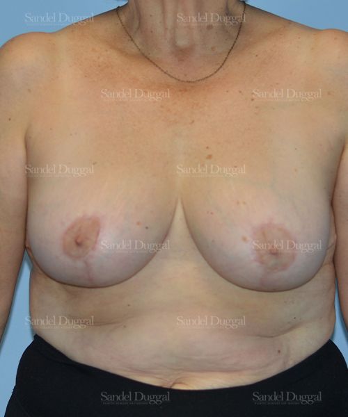 Breast Lift after, case 3287