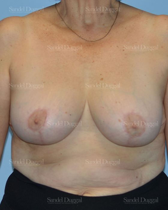 Breast Lift after, case 3287