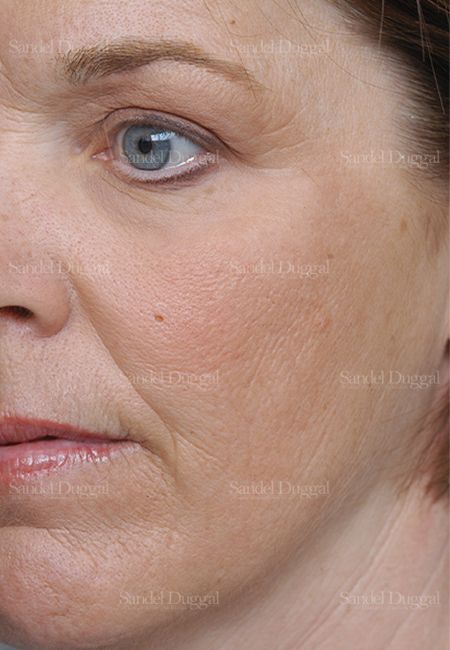 Laser Skin Resurfacing after, case 2981
