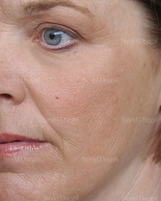 Laser Skin Resurfacing after, case 2981
