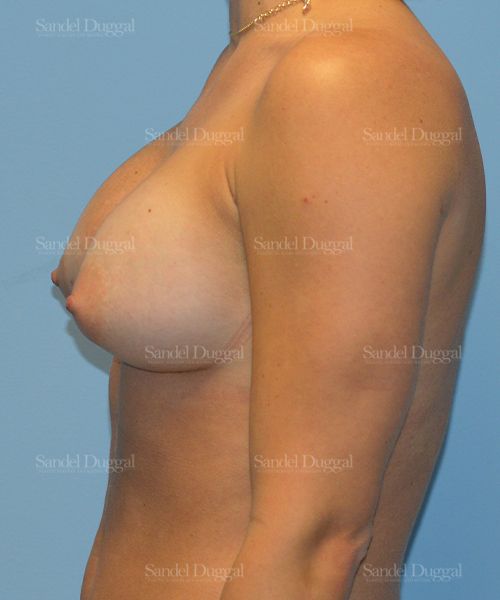 Breast Augmentation after, case 3213