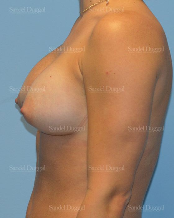 Breast Augmentation after, case 3213
