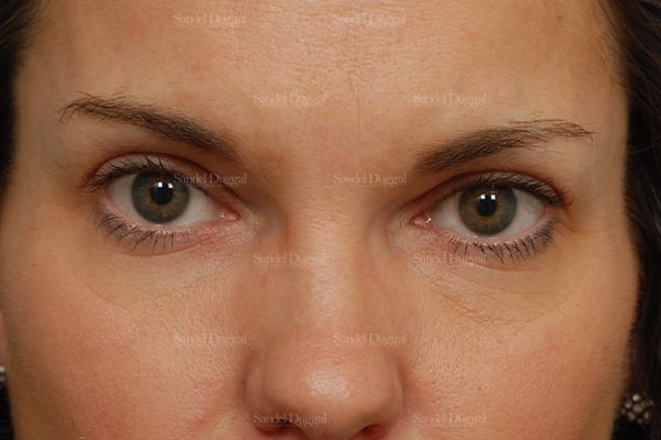 Botox & Fillers after, case 842