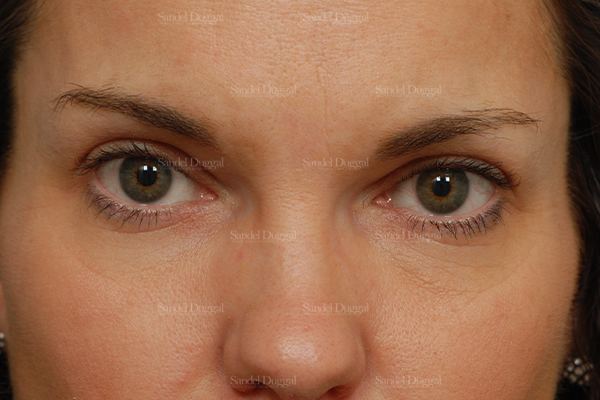 Botox & Fillers after, case 842