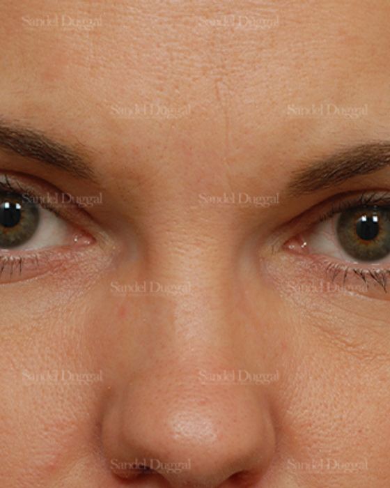Botox & Fillers after, case 842