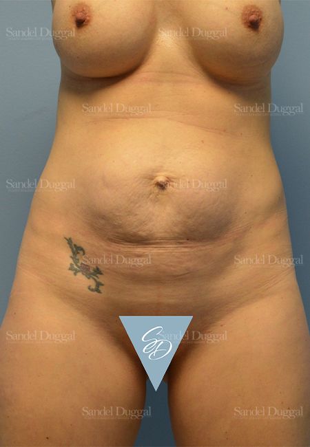 Mommy Makeover before, case 2176