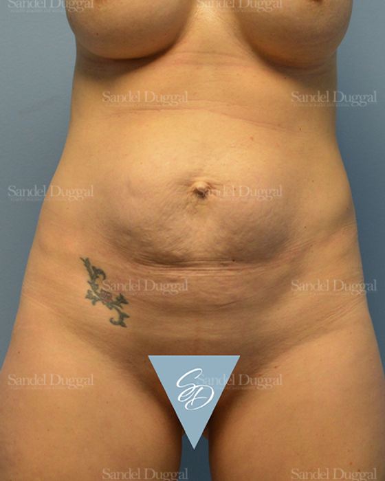 Mommy Makeover before, case 2176
