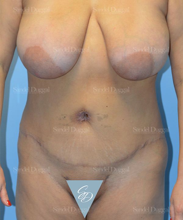 Liposuction — Abdomen after, case 2461
