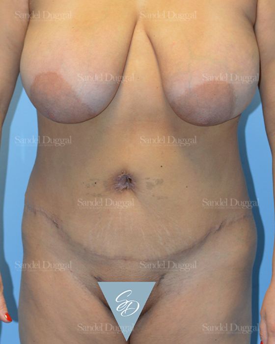 Liposuction — Abdomen after, case 2461