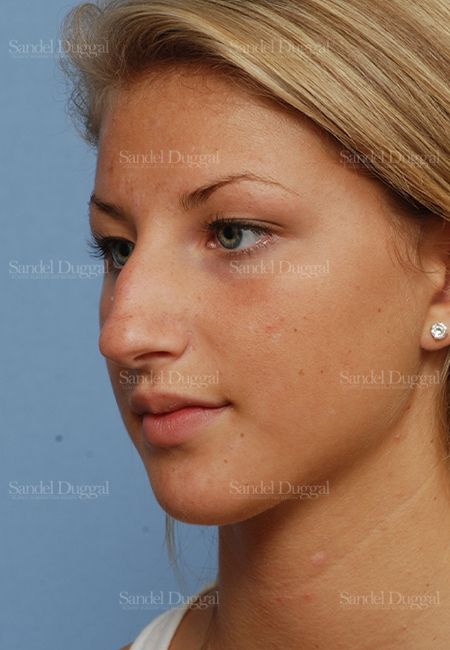 Rhinoplasty before, case 2876