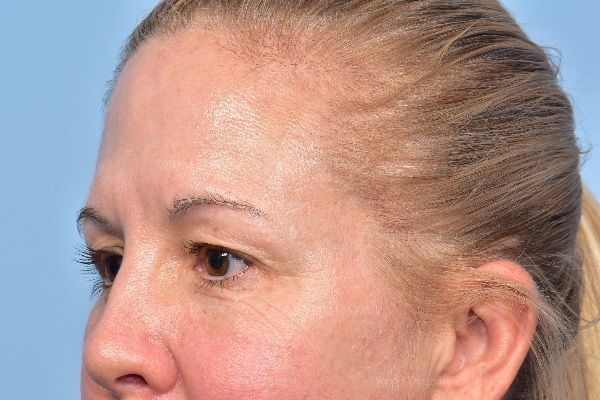 Eyelid Rejuvenation before, case 5322