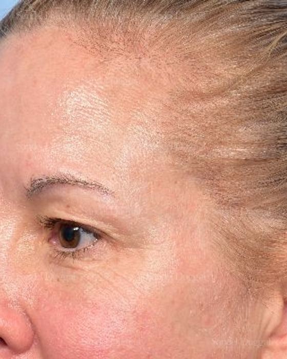 Eyelid Rejuvenation before, case 5322