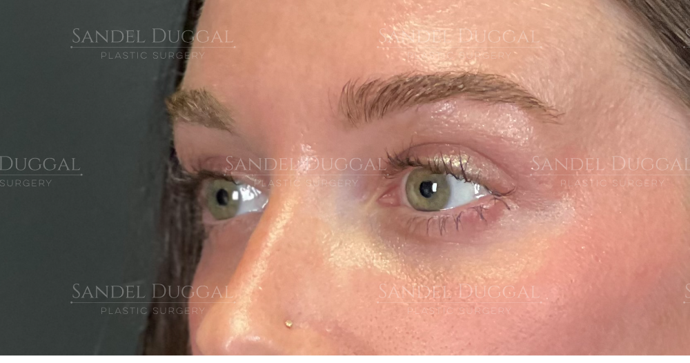 Eyelid Rejuvenation after, case 6001