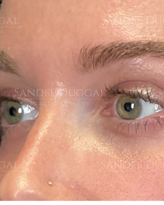 Eyelid Rejuvenation after, case 6001