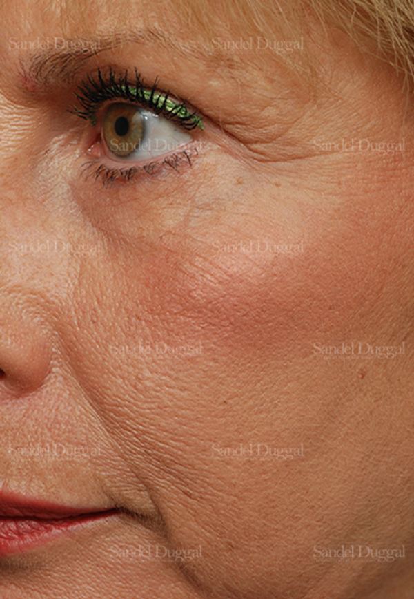 Laser Skin Resurfacing after, case 2966