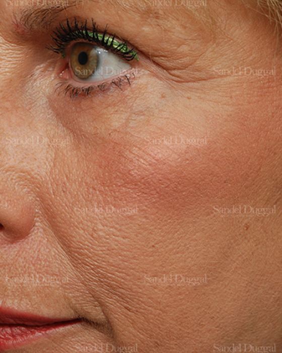Laser Skin Resurfacing after, case 2966