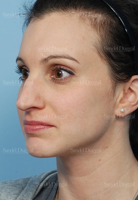 Rhinoplasty before, case 2831