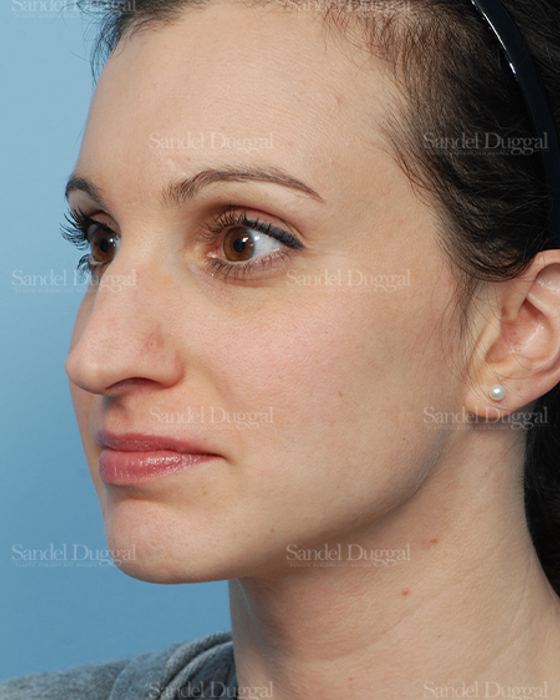 Rhinoplasty before, case 2831