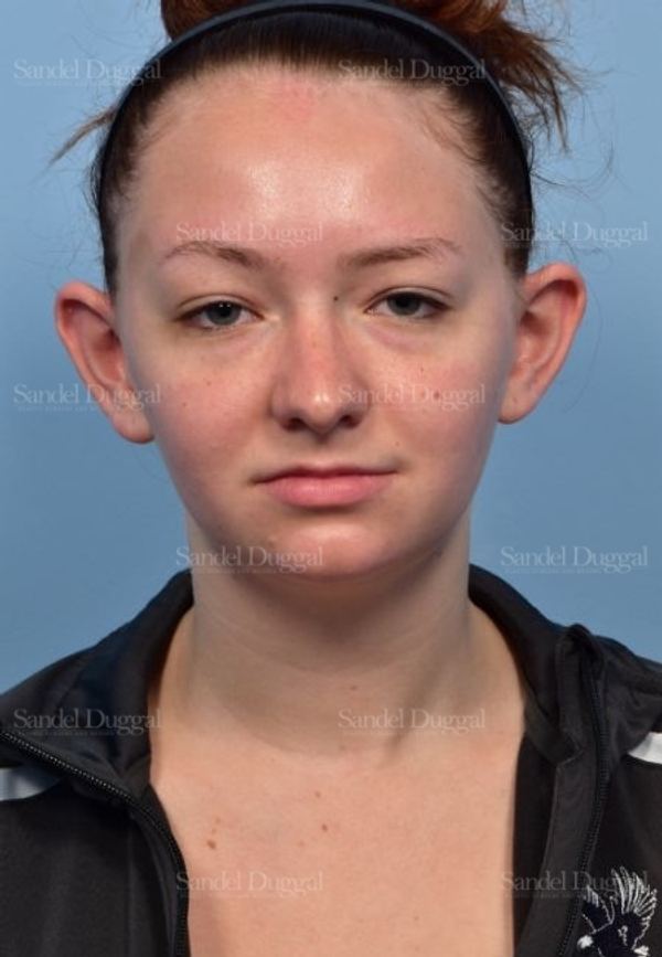Otoplasty before, case 4073