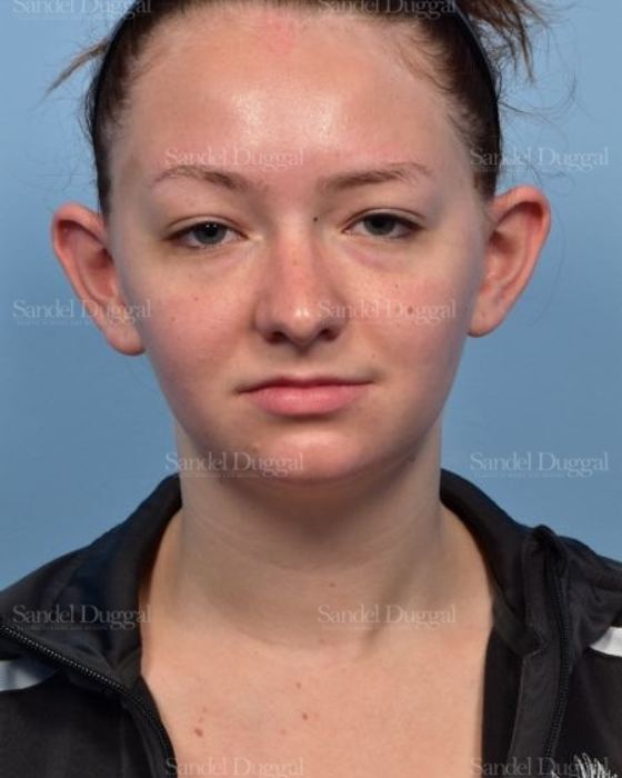 Otoplasty before, case 4073