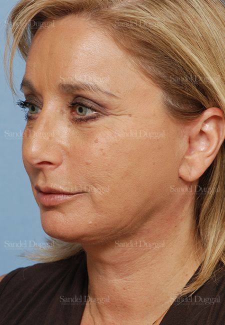 Facelift after, case 2714
