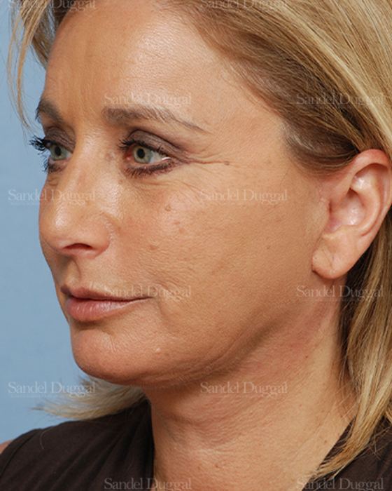 Facelift after, case 2714