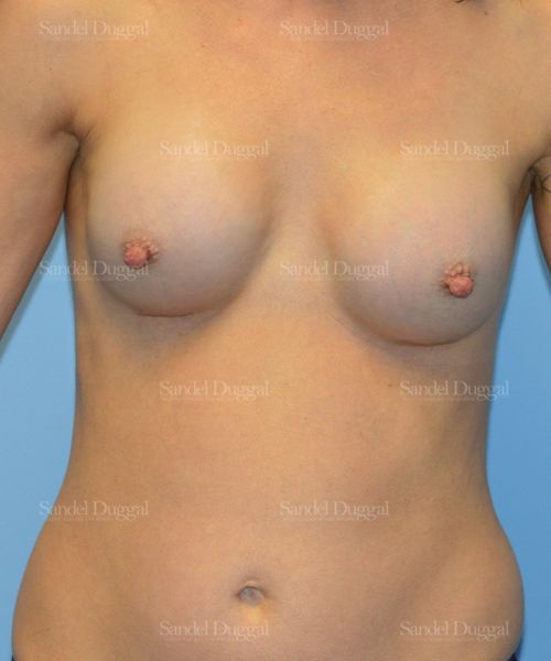 Breast Augmentation after, case 3136