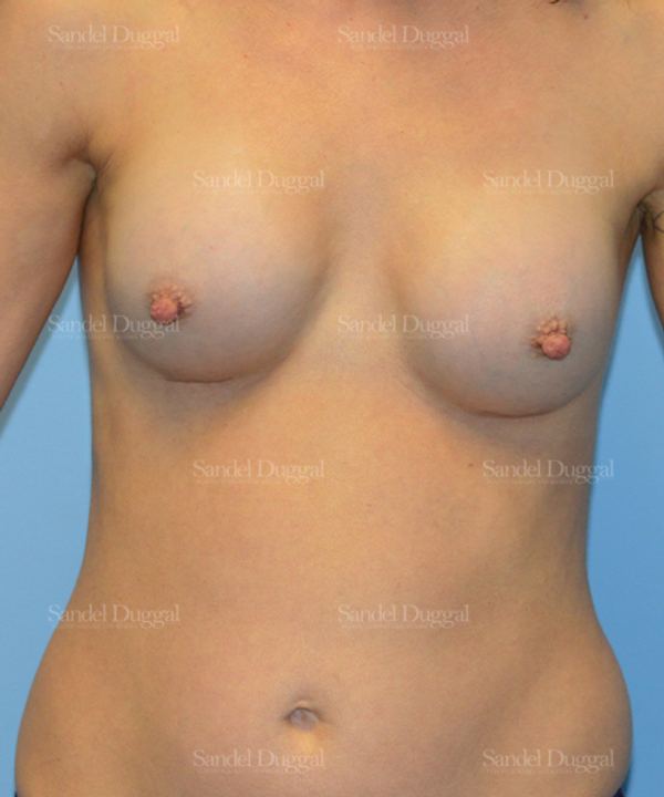 Breast Augmentation after, case 3136