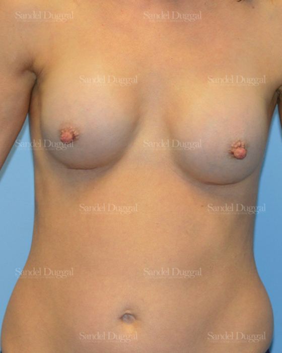 Breast Augmentation after, case 3136