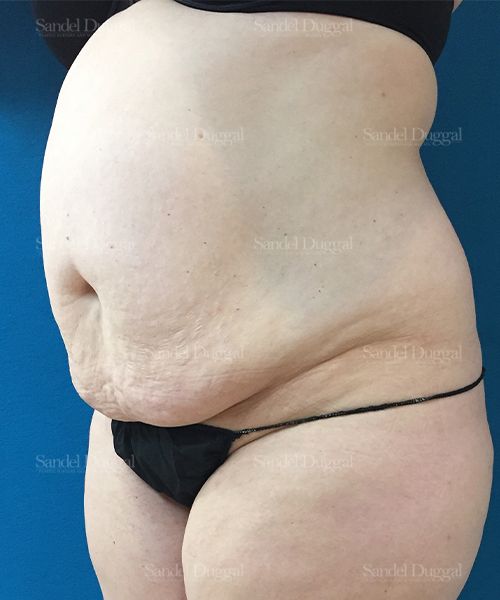Tummy Tuck before, case 1673